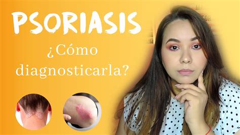 Tengo psoriasis, ¿cómo saber si tengo además artritis  